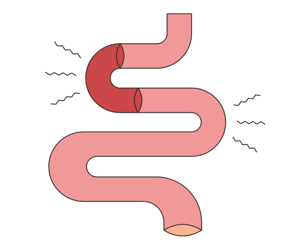 Dessin d'un intestin contenant une matière bloquée pour symboliser la constipation. Il illustre un article sur le Syndrome de l'Intestin Irritable rédigé par Maud Guillemet, Naturopathe à Besançon.